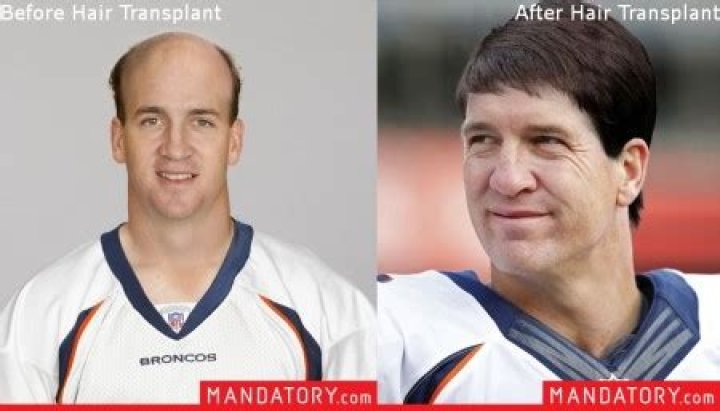 Did Peyton Manning Have Hair Transplant? Big Forehead Has Always Brought Him Luck